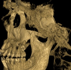 MindMap | Classification of Impacted 3rd Molar