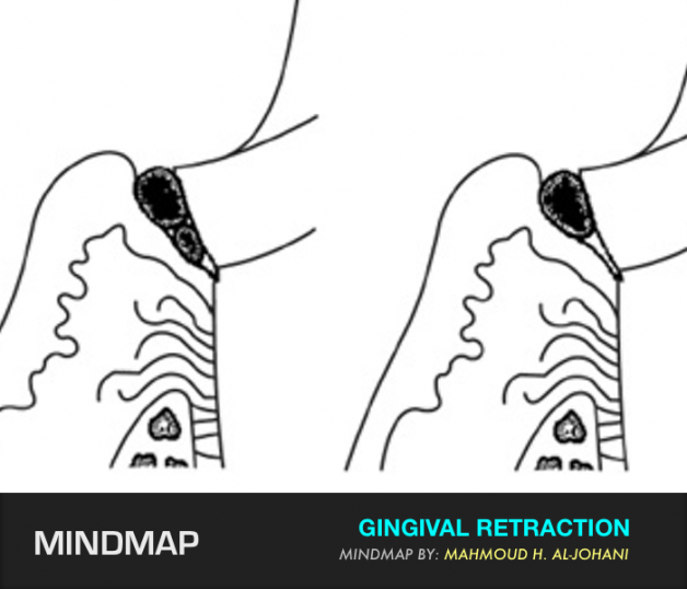Mindmap | Gingival Retraction