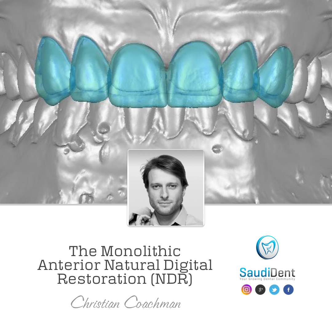 The Monolithic Anterior Natural Digital Restoration